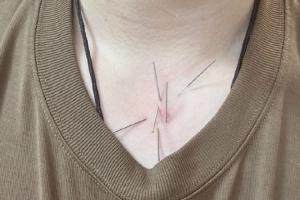 工作室曬趙繼偉頭&喉嚨針灸圖片：嗓子治療進入下一階段 加油??